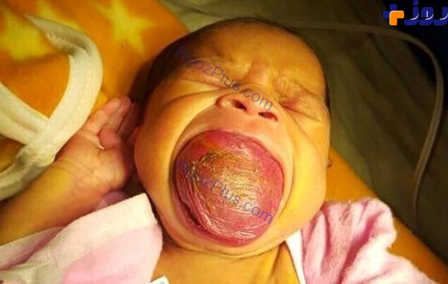 تولد دختری با زبان غول پیکر +تصاویر