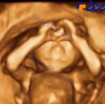 ژست جالب و عجیب جنین درون شکم مادرش + عکس