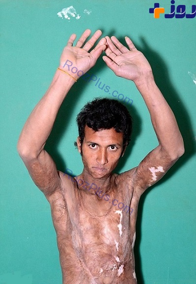 تصاویری از سوختگی وحشتناک پسر نپالی