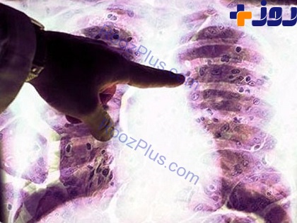 سایه سنگین سرطان بر خرابه های پلاسکو