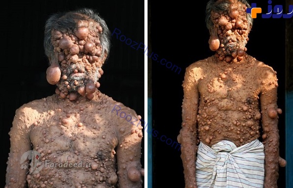 تصاویری آزاردهنده از تومورهای حبابی مرد بنگلادشی!