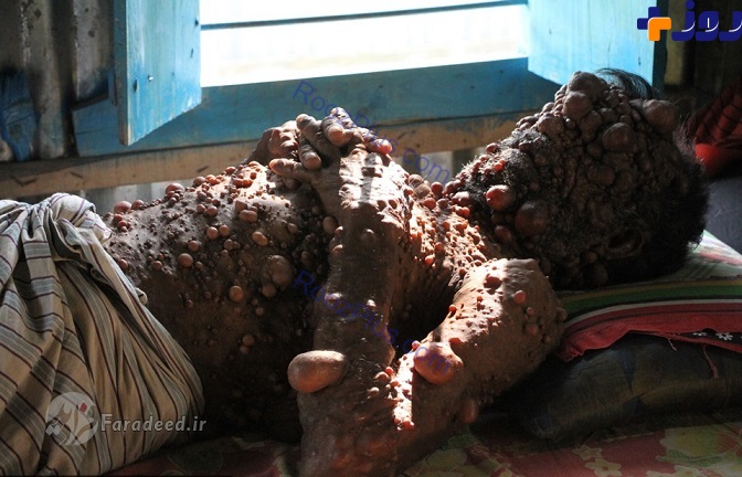 تصاویری آزاردهنده از تومورهای حبابی مرد بنگلادشی!