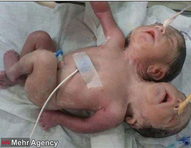 عکس/نوزادی با دو سر در هند به دنیا آمد!