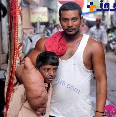 جوان هندی با دست 20 کیلویی اش خبرساز شد! +تصاویر