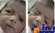 تیغ جراحی پلک نوزاد را برید +عکس
