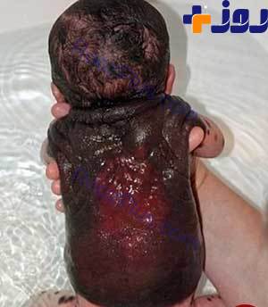 نوزادی که ۲۶ بار جراحی شد +عکس