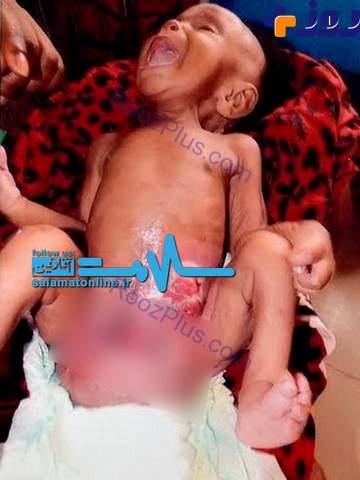 تولد نوزادی بدون مقعد و اندام تناسلی در نیجریه +عکس