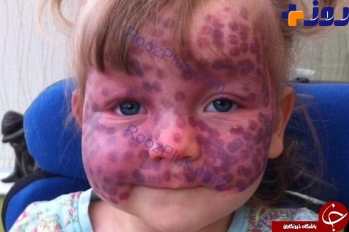 ماه گرفتگی عجیب روی پوست یک دختر بچه +عکس