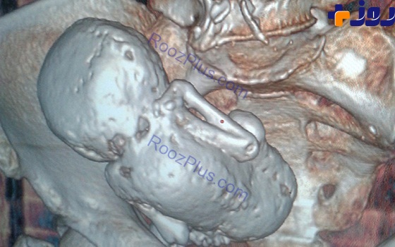 جنین سنگی 35 ساله در شکم این مادر + عکس