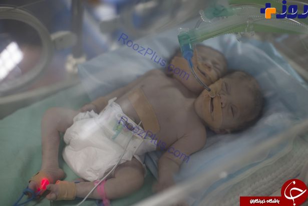 تولد نوزاد دو سر در نوار غزه +عکس