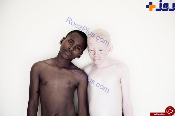 باوری عجیب در میان مردم تانزانیا درباره کودکان مبتلا به زالی +تصاویر
