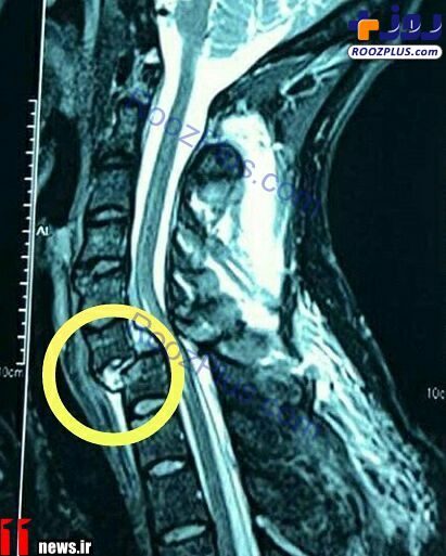 تصویر دلخراش از مهره گردن شکسته شده بازیکن استقلال