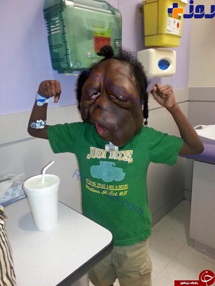 تغییر شکل عجیب پسر 8ساله بخاطر تومور بدخیم! +تصاویر