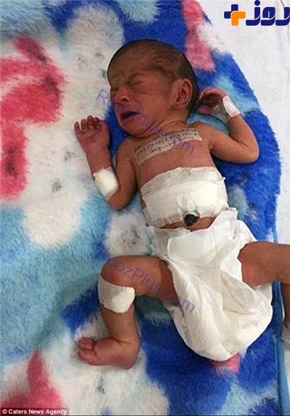 نوزاد دو سر در هندوستان جراحی شد + عکس