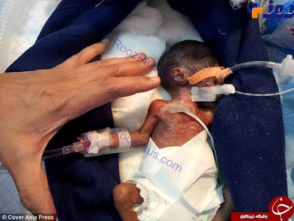 کوچکترین نوزاد جهان به اندازه کف دست +تصاویر