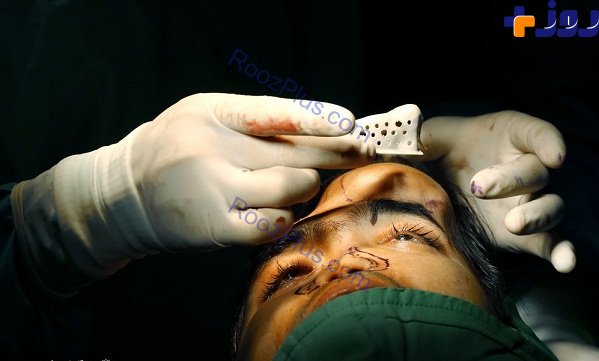 بازسازی کامل بینی و بخشی از صورت یک بیمار توسط جراحان ایرانی +تصاویر