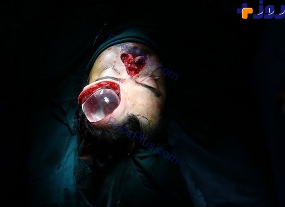 بازسازی کامل بینی و بخشی از صورت یک بیمار توسط جراحان ایرانی +تصاویر