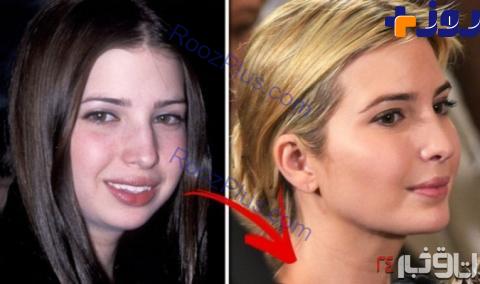 «ایوانکا ترامپ» قبل و بعد از عمل زیبایی +تصاویر