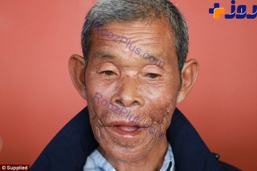 توموری وحشتناک در صورت مرد آسیایی/ تصاویر 16+