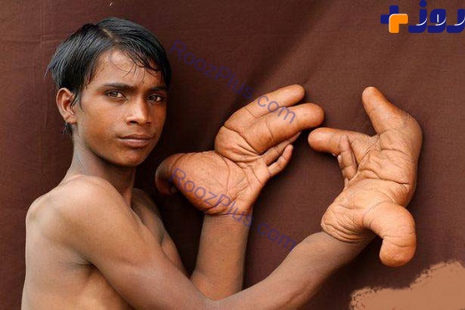 انگشتان غول پیکر و غیر عادی یک پسر جوان+عکس