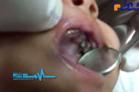 جراحی 7 دندان کودک یک ماهه! +تصاویر