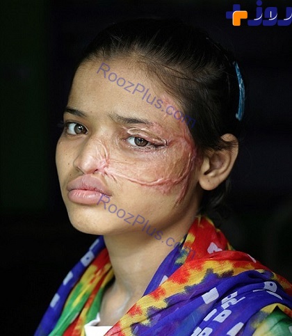 اسیدپاشی وحشیانه پدری روی صورت دخترش! + تصاویر