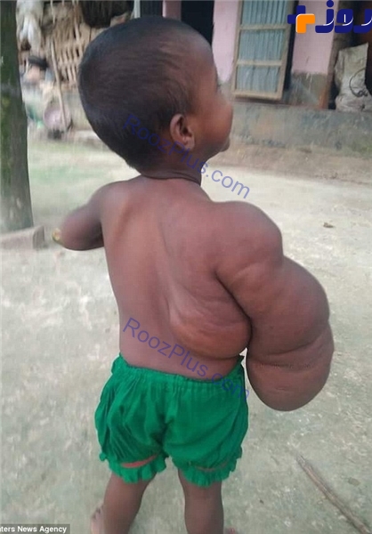 بیماری هولناک کودک 2 ساله +تصاویر