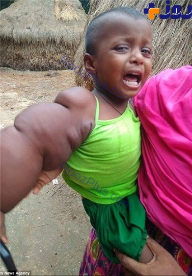 بیماری هولناک کودک 2 ساله +تصاویر