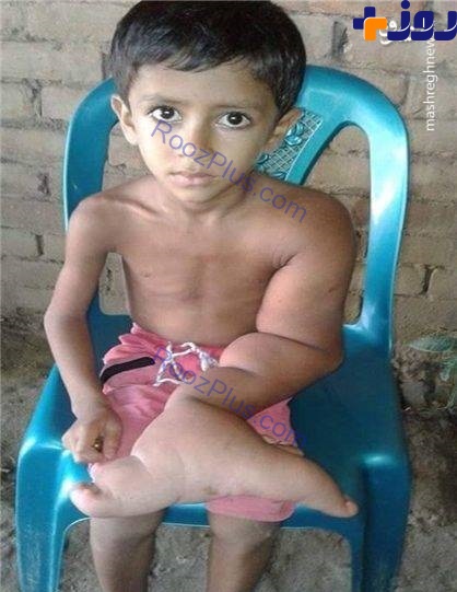 دست عجیب پسر 5 ساله بنگلادشی +تصاویر