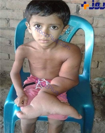 بیماری عجیب پسربچه بنگلادشی +تصاویر
