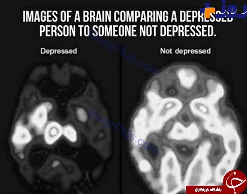 تصویری عجیب از مغز افراد افسرده!