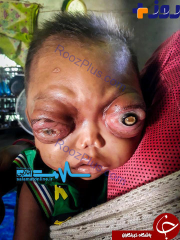 بیماری چشمی نادر و وحشتناک کودک نوپا +تصاویر