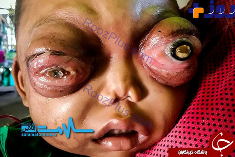 بیماری چشمی نادر و وحشتناک کودک نوپا +تصاویر