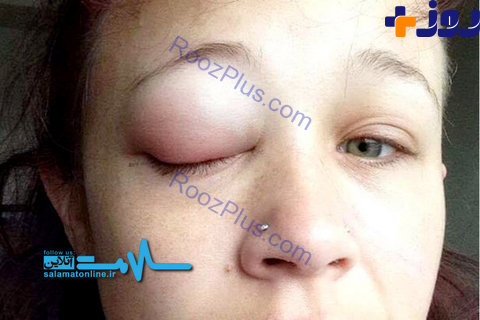 اقدام عجیب دختر جوان برای تتوی چشم او را کور کرد! +تصاویر
