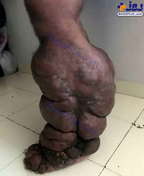 تغییر شکل وحشتناک پای مرد هندی در اثر گزیدن پشه!/ تصاویر18+