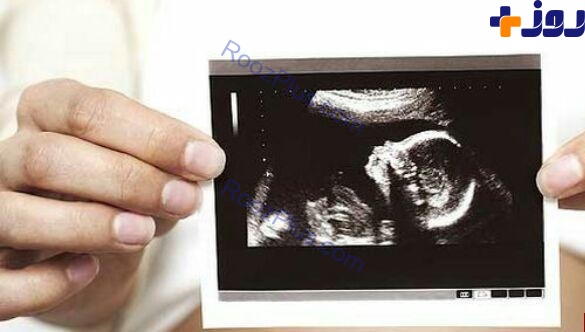 جنین ترسناک در سونوگرافی باعث وحشت زن باردار شد+عکس
