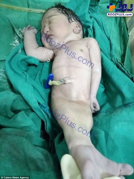 تولد نوزادی شبیه به پری دریایی در هند +تصاویر