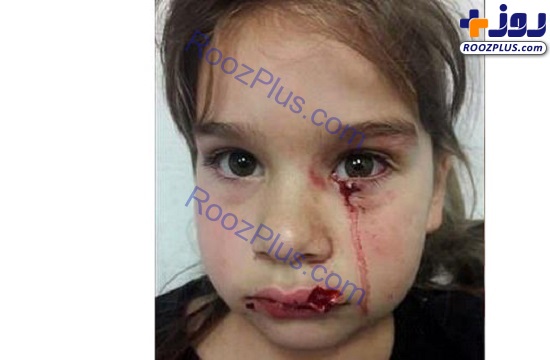 حمله سگ وحشی به دختر ۵ ساله در فرودگاه! +عکس