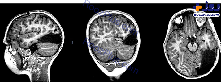 عکس/ ترمیم باورنکردنی مغز پسر ۷ ساله