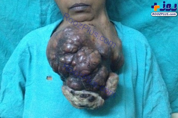 تومور ۵ کیلویی در چانه یک زن+تصاویر