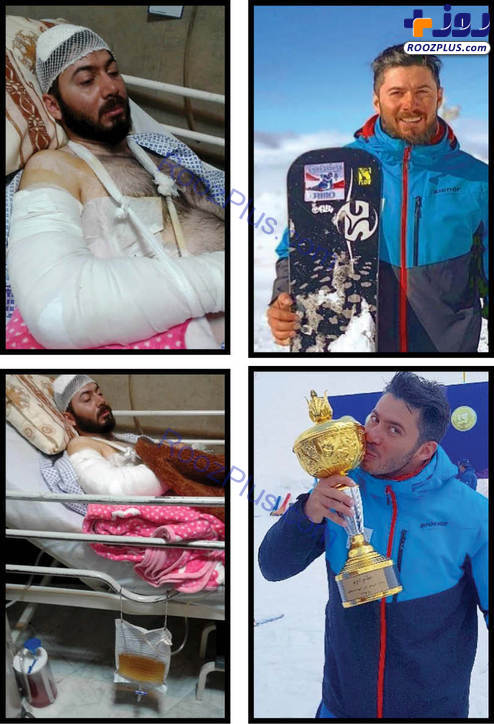 حمله خونین با قمه به قهرمان اسکی ایران در شمشک +عکس