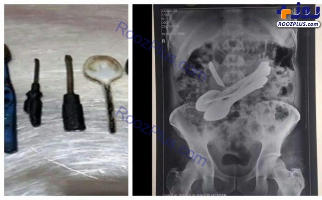 عکس/ خارج کردن قاشق، چاقو و پیچ‌گوشتی از شکم یک بیمار 35 ساله هندی!