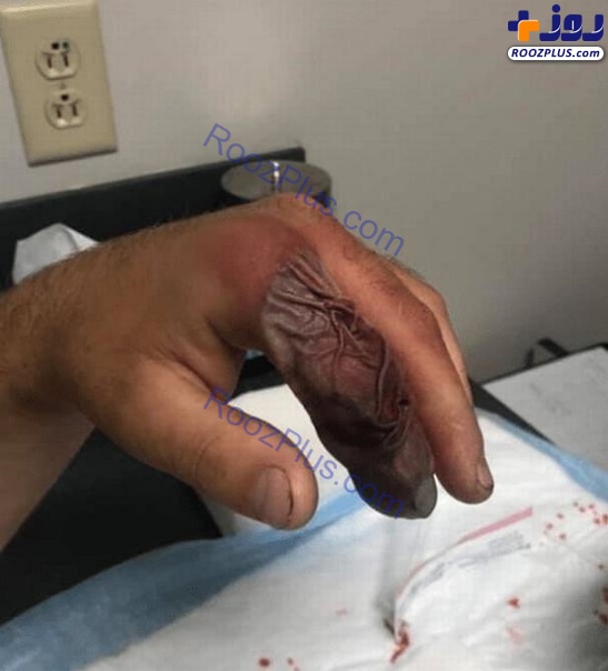تغییر عجیب انگشتان دست یک مرد بر اثر مارگزیدگی + تصاویر (۱۸+)
