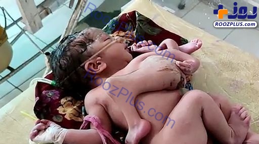 تولد نوزادی عجیب با ۴ پا و ۳ دست!+تصاویر