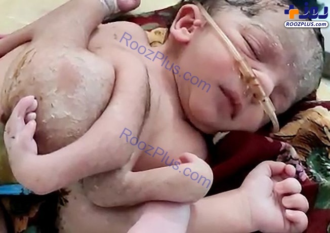تولد نوزادی عجیب با ۴ پا و ۳ دست!+تصاویر