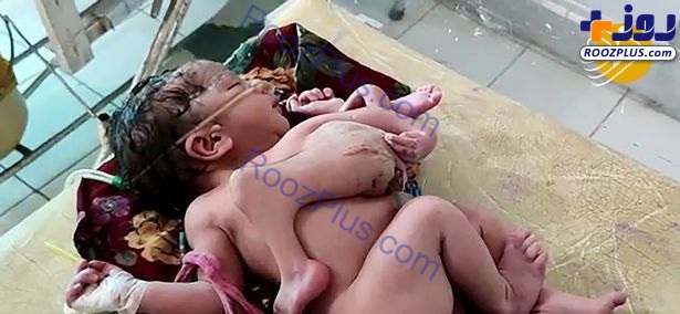 عکس/تولد نوزادی عجیب با ۴ پا و ۳ دست!!!!