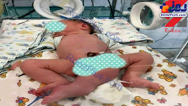 تولد نوزادی که  3 پا دارد+ عکس