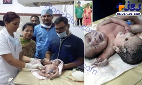 تولد نوزاد دو سر در هندوستان! +عکس