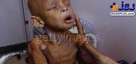 عکس/تصاویری جانکاه از سوءتغذیه و رنج کودکان یمنی