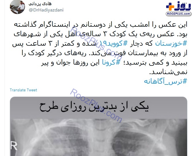 تصویری تکان دهنده از ریه کودک کرونایی در بیمارستان خوزستان
